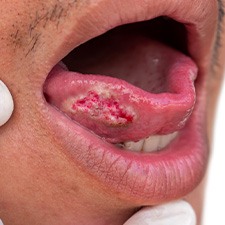 Oral cancer lesion on the tongue