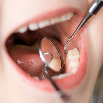 Closeup of children’s dental sealants being placed
