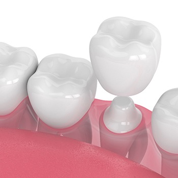 Diagram of how dental crowns in Allen are placed