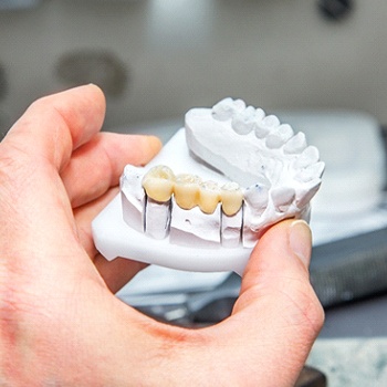 Dental bridge in Allen on mold of lower arch