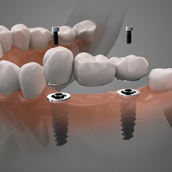 Digital illustration of implant dental bridge in Allen