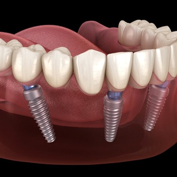 model of implant-retained denture on bottom arch