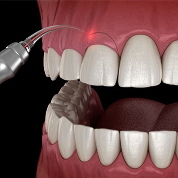 Gum recontouring in Allen 