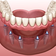 A 3D illustration of an implant denture
