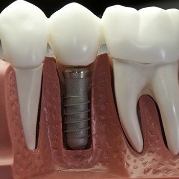 Model of dental implant in gums with natural teeth.