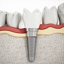 Aniamted implant supported dental crown