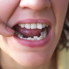 Closeup of crowded teeth