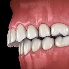 Digital illustration of an overbite