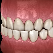 Digital illustration of an underbite