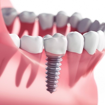 Animated dental implant supported dental crown restoration