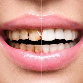 Smile before and after full mouth reconstruction in Allen