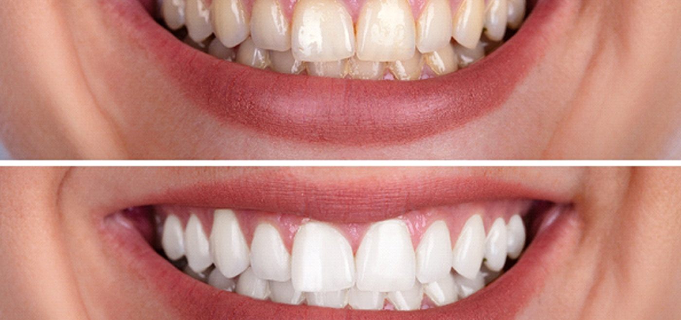 Teeth whitening before and after