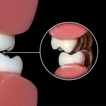 Closeup of model smile showing damage from teeth grinding