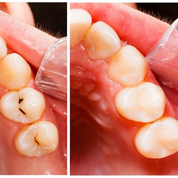 before and after photos of a tooth-colored filling treatment