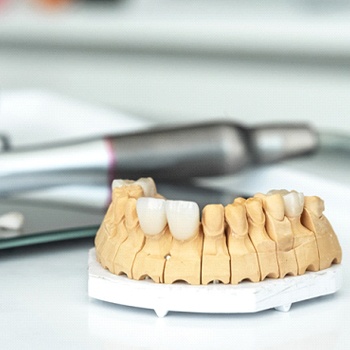 model of a mouth with porcelain veneers on it