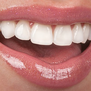 Closeup of beautiful smile with veneers in Allen