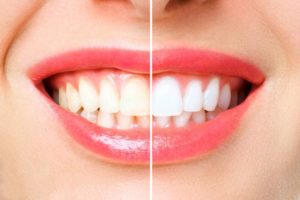 closeup of teeth whitening treatment 