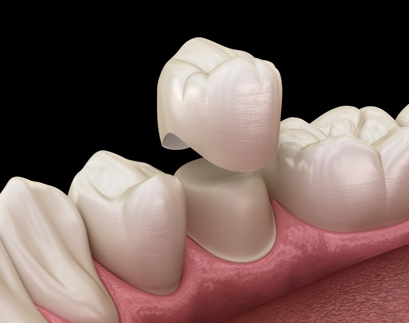 3-D model of a dental crown 