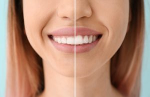 a before and after of a woman’s smile with gum recontouring