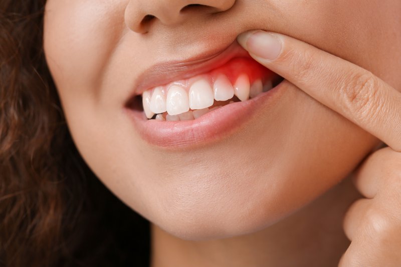 a person showing signs of gingivitis in their smile